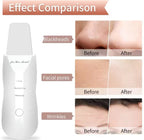 Ultrasonic Skin Scraper Deep Cleaning & Blackhead Remover Facial Spatula
