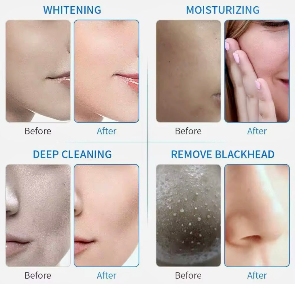 6-in-1 Hydrodermabrasion Machine Hydro Water Jet Peel & Skin Whitening Device