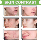 Acne Repair Exfoliating Gel Clears Acne, Refines Pores & Controls Oil