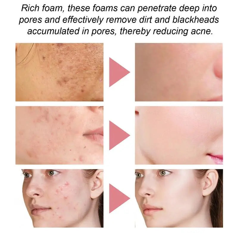 Facial Foaming Cleanser – Deep Clean, Oil Control, Moisturizing, Blackhead Removal