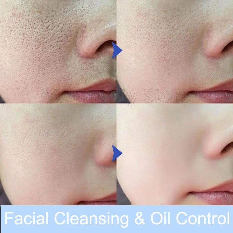 Facial Foam Cleanser – Gentle Pore Cleanser & Oil Control (80g)