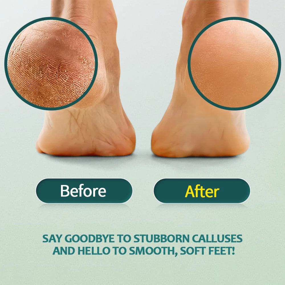 Nailpop Professional Callus Remover Kit – Extra Strength Gel & Foot Rasp File for Cracked Heels & Dead Skin