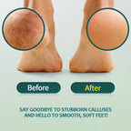 NAILPOP Foot Care Callus Softener Combo – Callus Remover Gel & Foot File Set for Dry, Rough, Cracked Heels